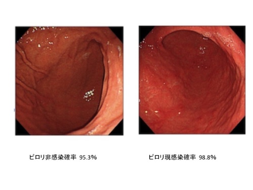 写真1　ピロリ胃炎の診断支援ツールの画面表示イメージ。内視鏡画像から、ピロリ菌の感染率（もしくは未感染率）を表示する。