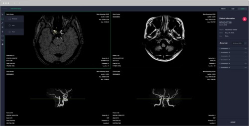 「EIRL aneurysm」で脳MRI画像を解析した例、検出部位には円形マークが重なる。横の数字は事前に学習させた脳動脈瘤の疾患部位が含まれている画像との類似度を示している（類似度が高い順に1、2、3...と続く、最大で5個まで検出する）