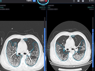 新型肺炎をAIで診断支援、中国のIT企業が武漢市の医師らとシステムを開発