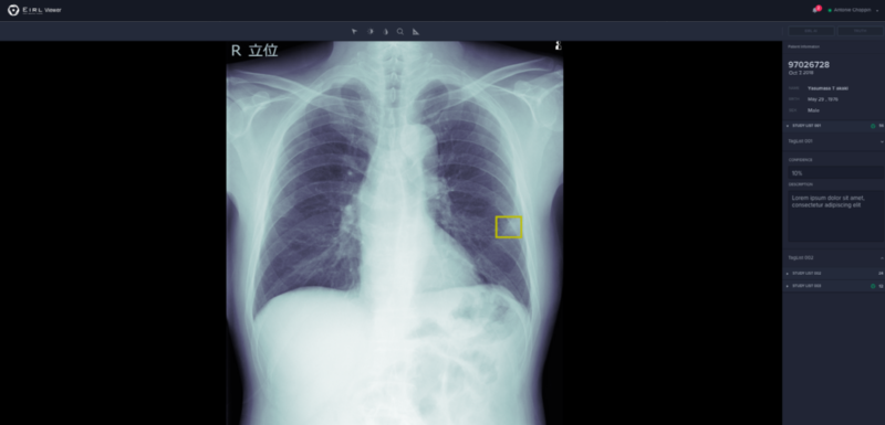 エルピクセルが健康診断向けに新たな画像診断支援aiソフト どう普及させるか 日経クロステック Xtech