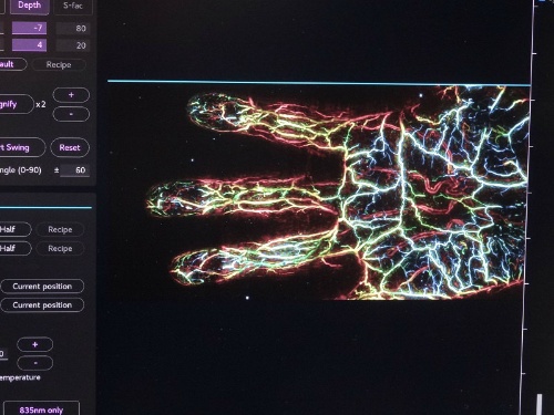 図2　光超音波イメージングで画像化した血管