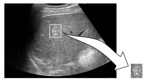 学習に使った超音波画像のイメージ。拡大部分が肝腫瘤