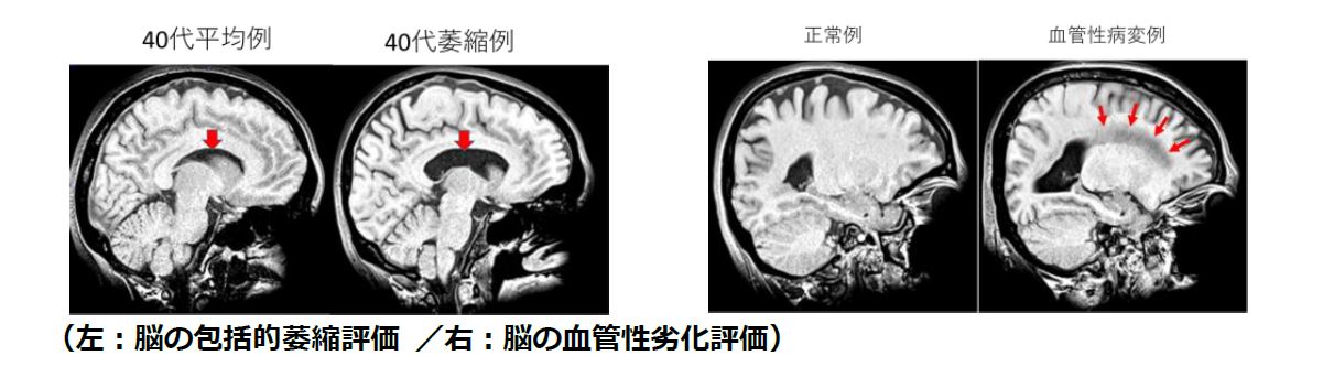 人工知能を活用した脳MRI画像解析の理論と実践 - 本