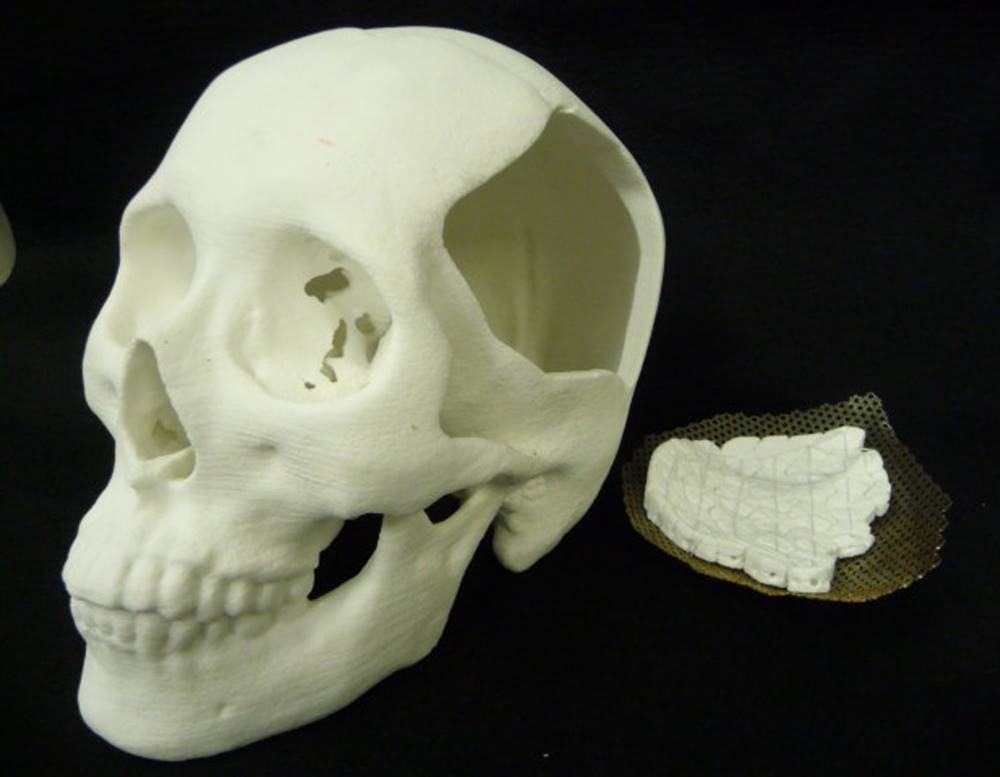 メッシュプレートと人工骨を組み合わせた「Hybrid-Bone Matrix」で骨の欠損部を治療する
