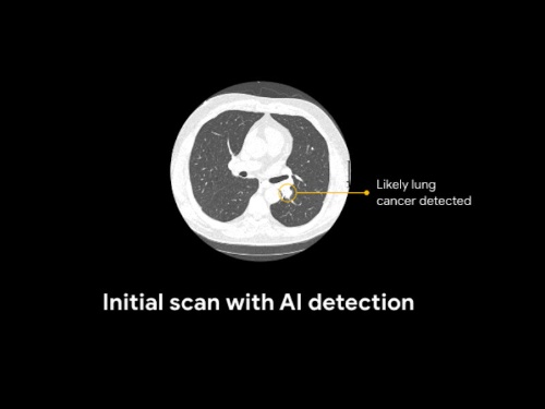 CTスキャン画像から肺がんを診断しているイメージ図