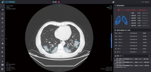 インファービジョンが開発したAIを搭載したCESデカルトの肺画像解析システムの画面（画像提供：CESデカルト）