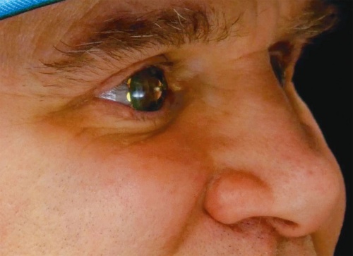 図1　Mojo Lensを自分の眼に装着したCEOのPerkins氏