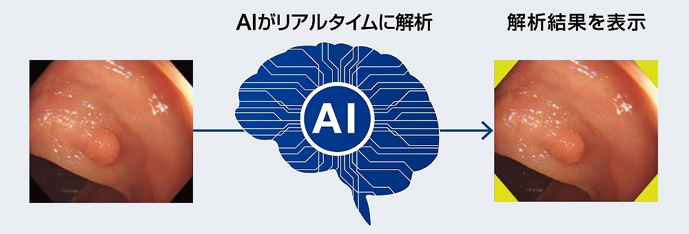 Aiがリアルタイムで大腸病変を検出 オリンパスの診断支援ソフト 日経クロステック Xtech